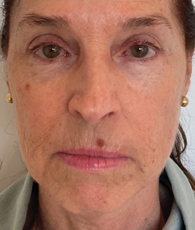 XERF — 1 Treatment (after)