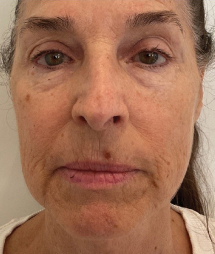 XERF — 1 Treatment (before)