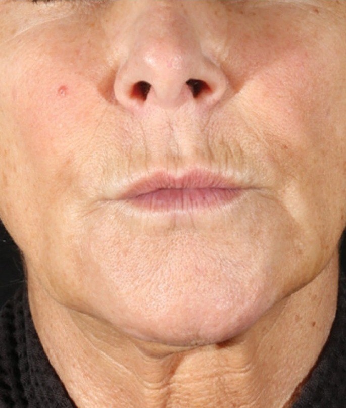 XERF — 2 Treatments (after)