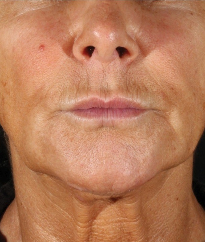 XERF — 2 Treatments (before)