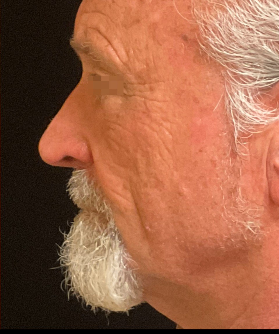 XERF — 3 Treatments (after)