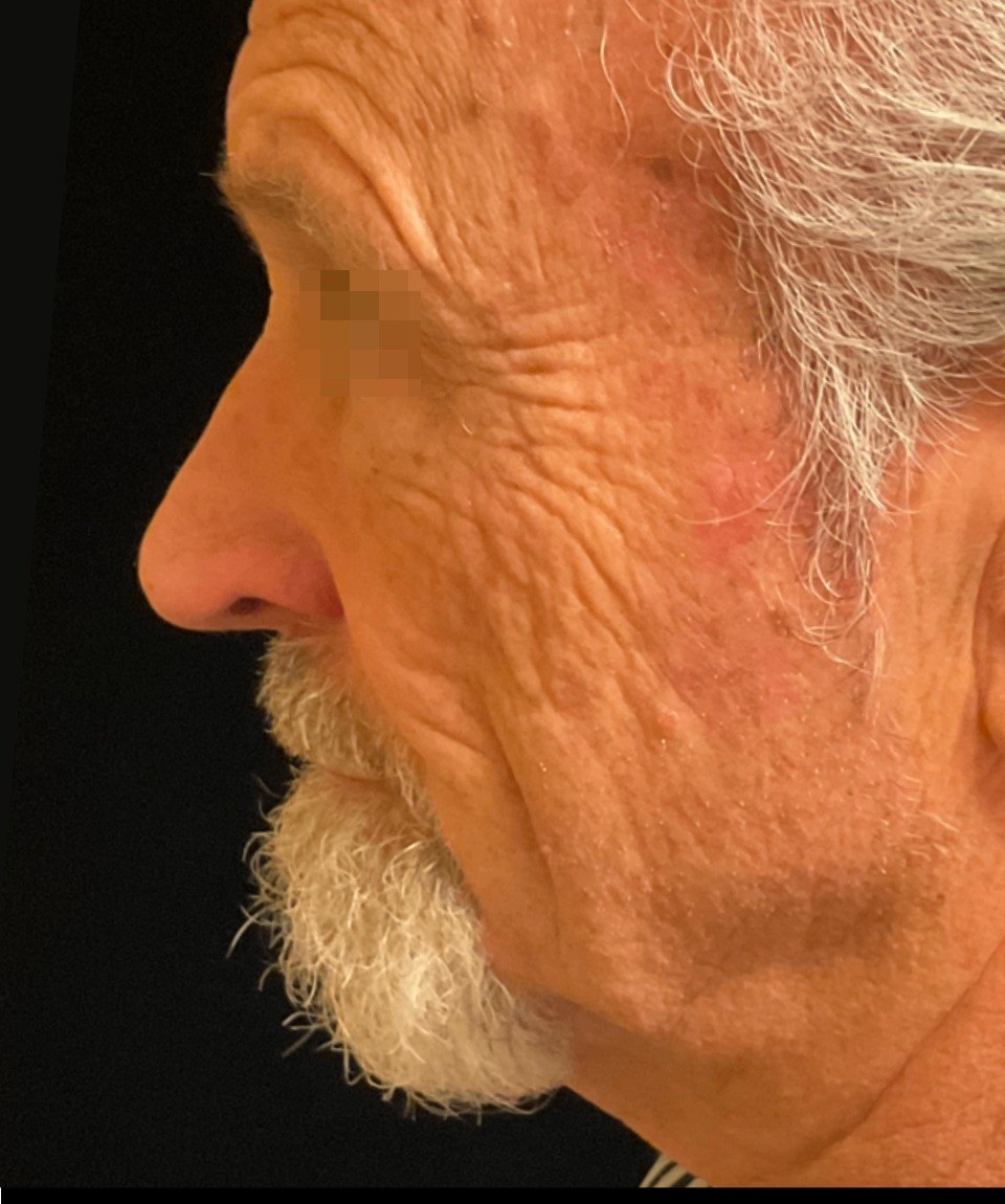 XERF — 3 Treatments (before)