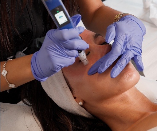 SkinPen microneedling at Lavish Laser MedSpa